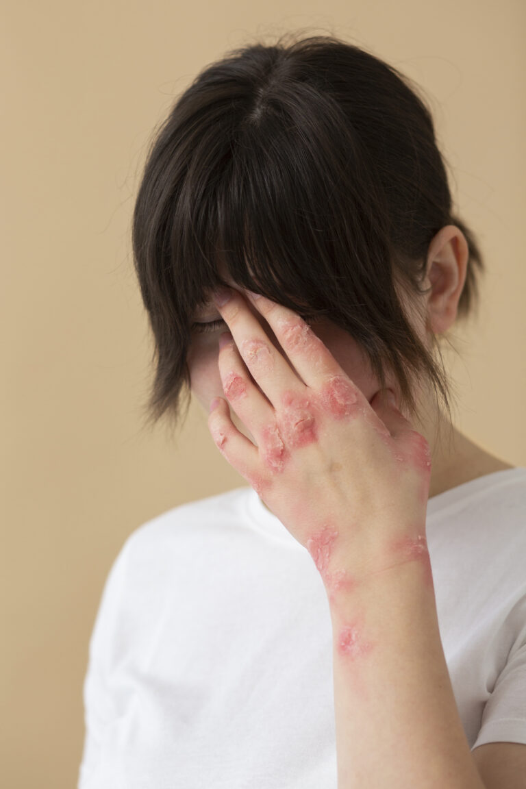 มอยส์เจอไรเซอร์มีบทบาทอย่างไรต่อผู้ที่เป็นโรคสะเก็ดงิน (Psoriasis)