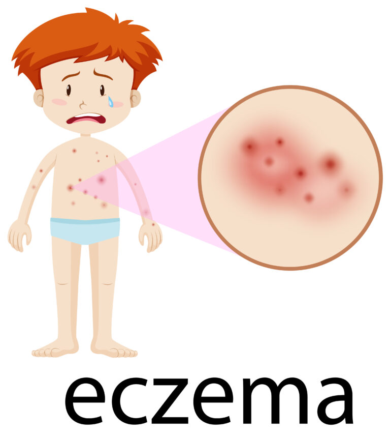 Eczema ผิวอักเสบ คัน แห้งแตก…รักษาอย่างไรให้ผิวกลับมาแข็งแรง?